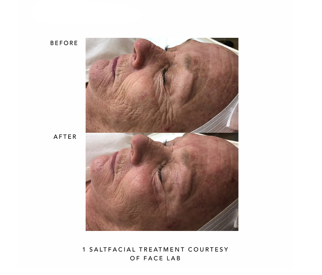 The Salt Facial Skin Renewal Therapy Treatment By SaltMed