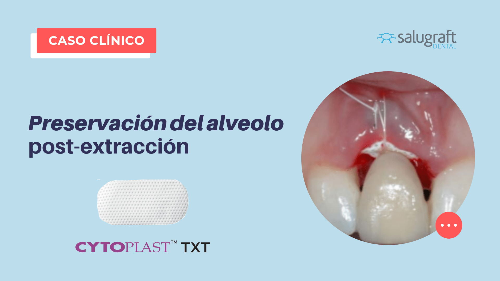 Caso de Preservación alveolo postextracción con Cytoplast TXT Salugraft