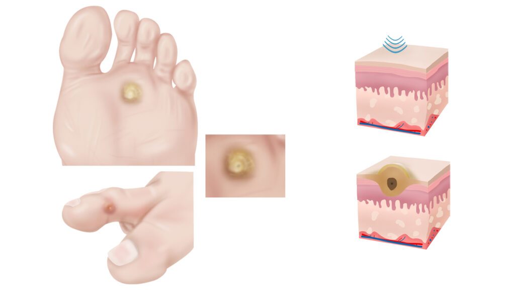 Corns on feet symptoms and treatment Salvequick