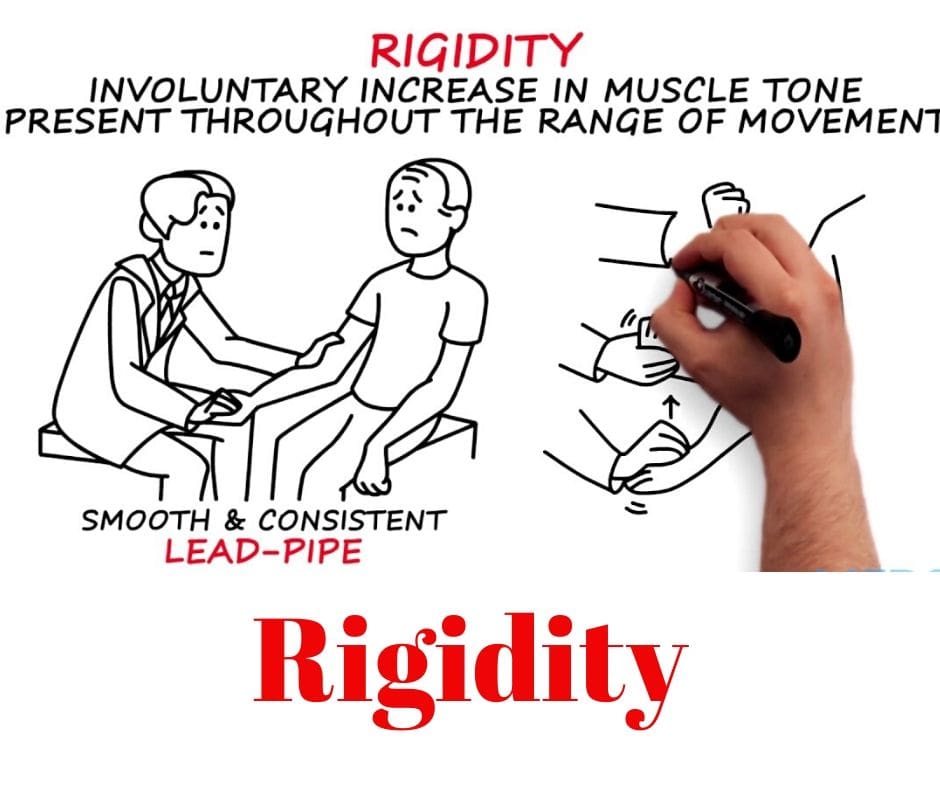 What are Spasticity and Rigidity? Spasticity Rigidity Comparison