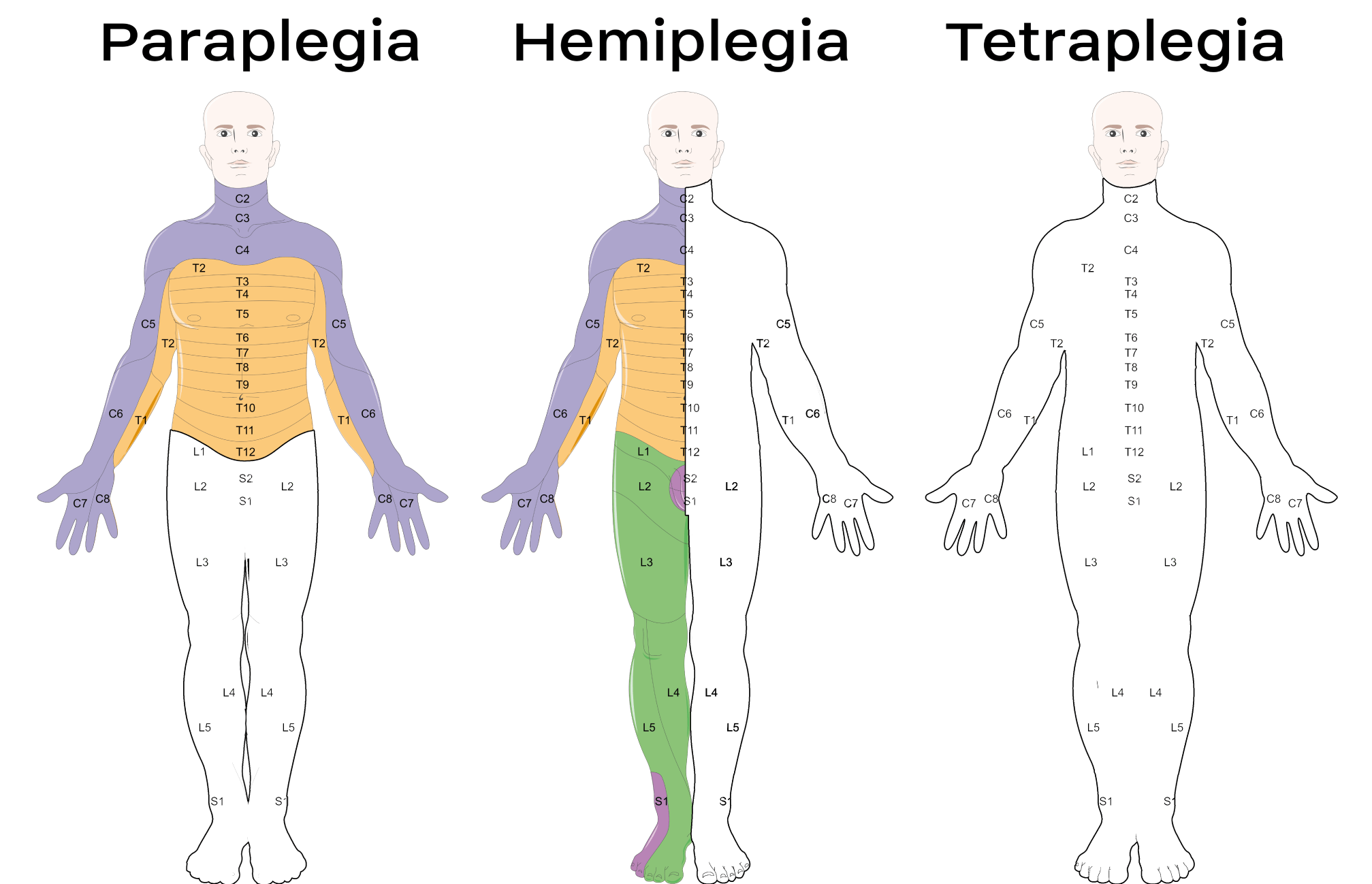 Tetraplegia Cause, Symptoms, Treatment, Exercise