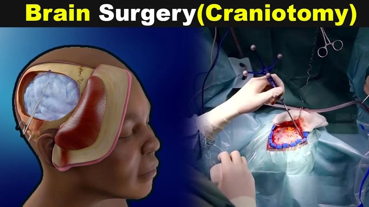 Craniotomy Types, Indication, Contraindication