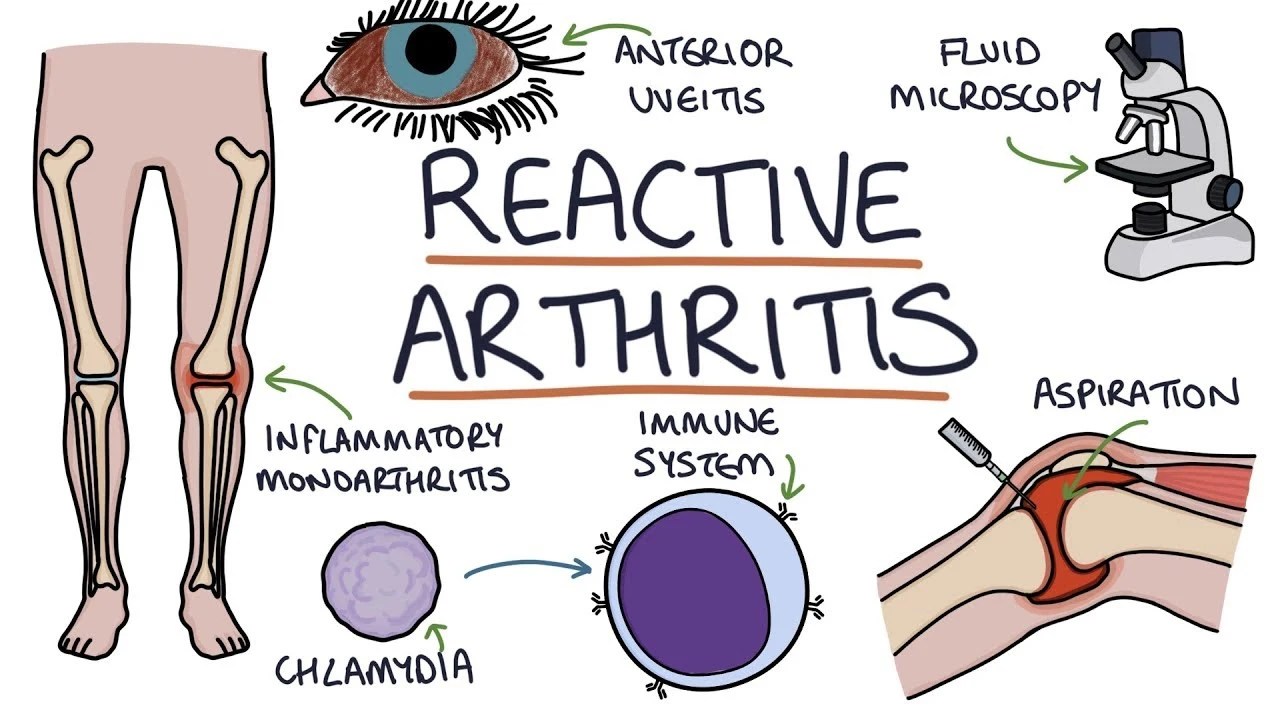 Reactive arthritis Cause, Symptoms, Diagnosis, Treatment