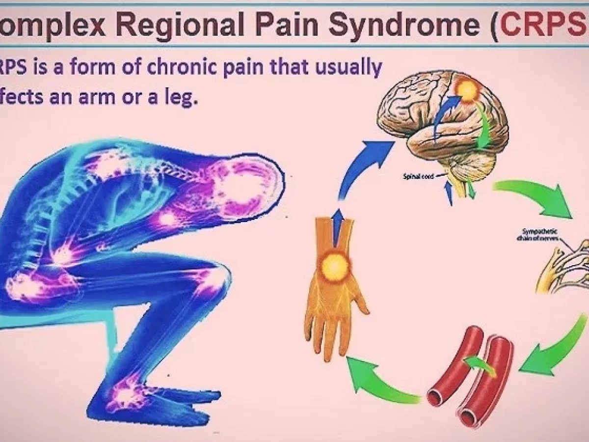 Complex Regional Pain Syndrome (CRPS) Causes Symptoms, 55 OFF
