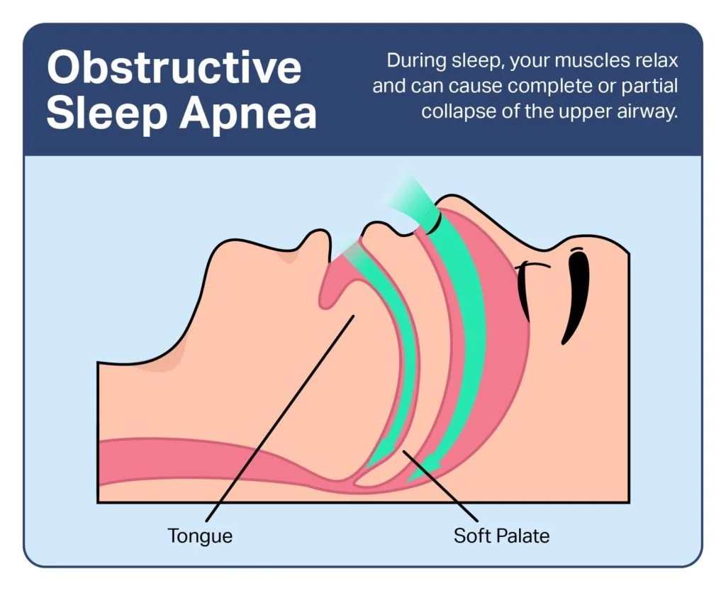 obstructive sleep apnea treatment Archives Samarpan Physiotherapy Clinic