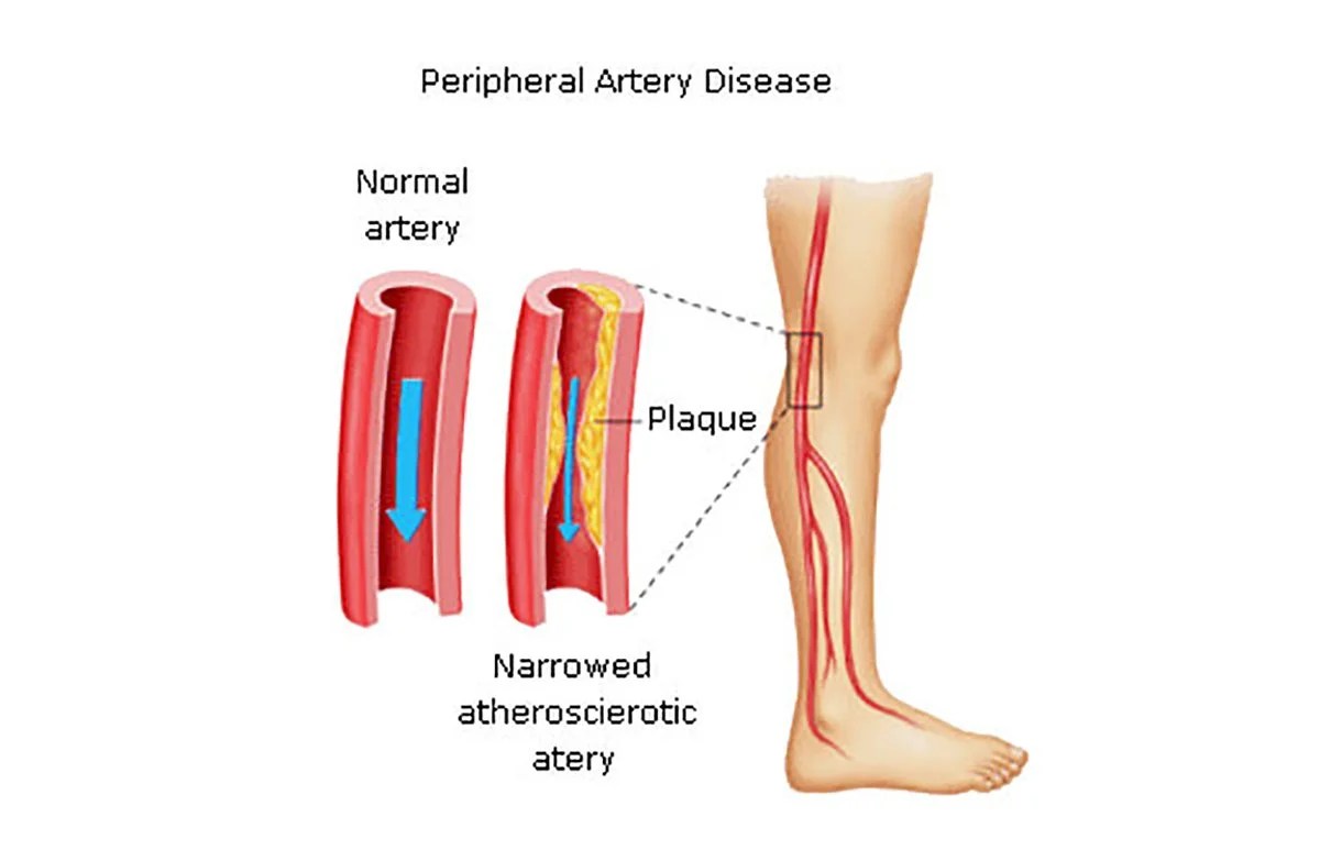 Peripheral Artery Disease Cause, Classification, Treatment