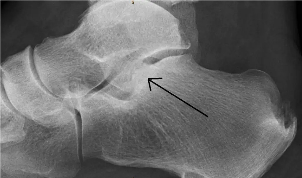 Subtalar Osteoarthritis Cause, Symptoms, Treatment, Exercise