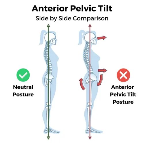 How to fix Anterior Pelvic Tilt? Exercises, Stretches, and More