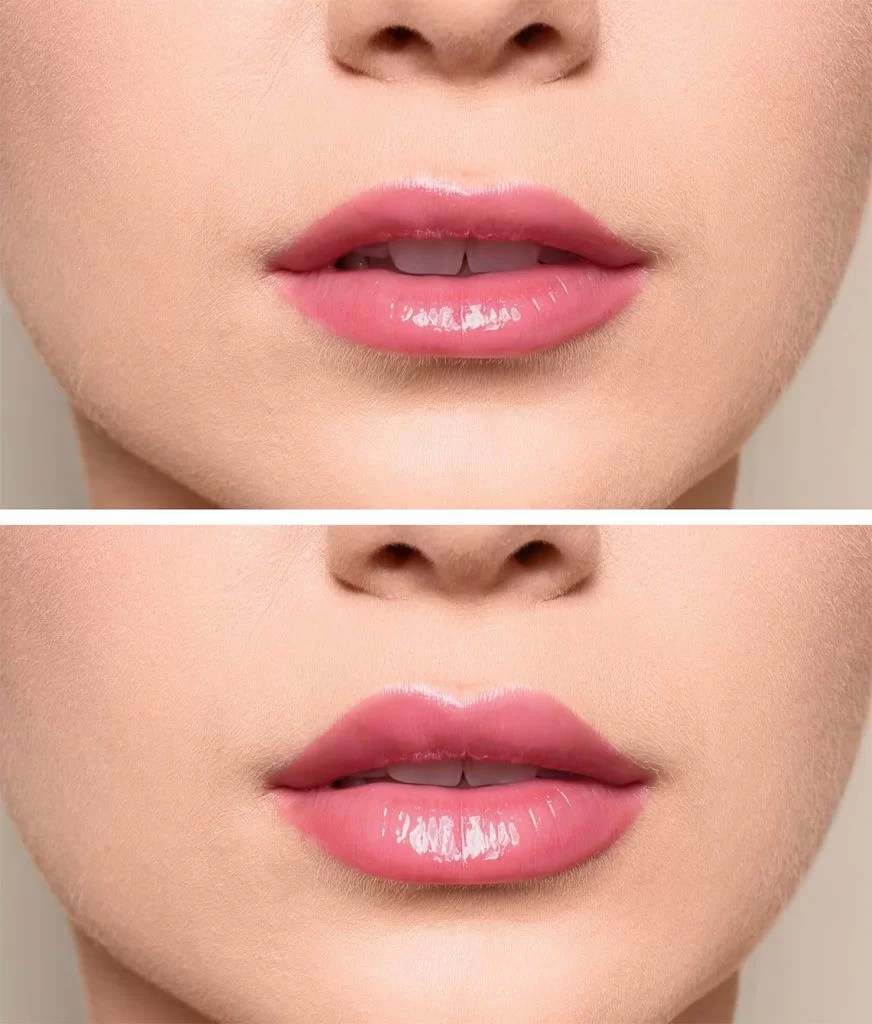 Top lip Filler Near Me Sama MedSpa