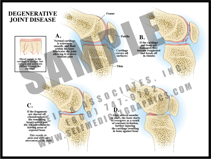 Degenerative Joint Disease S&A Medical Graphics