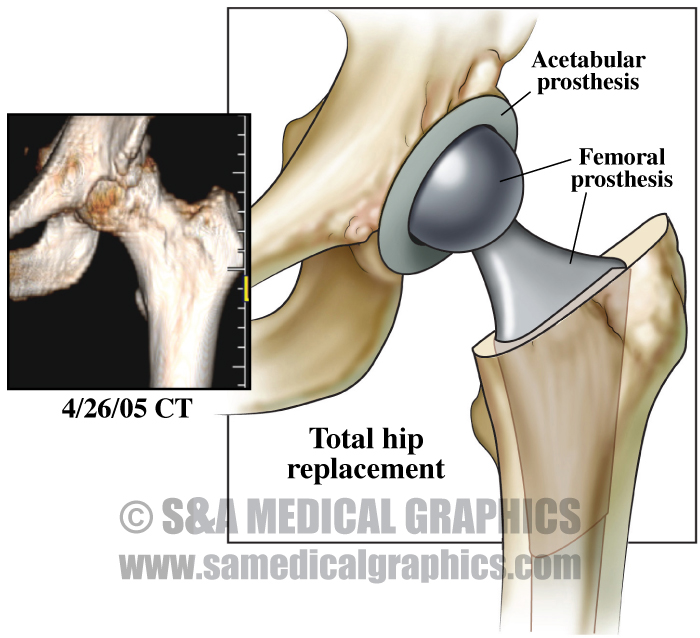 Total Hip Replacement Case Study S&A Medical Graphics