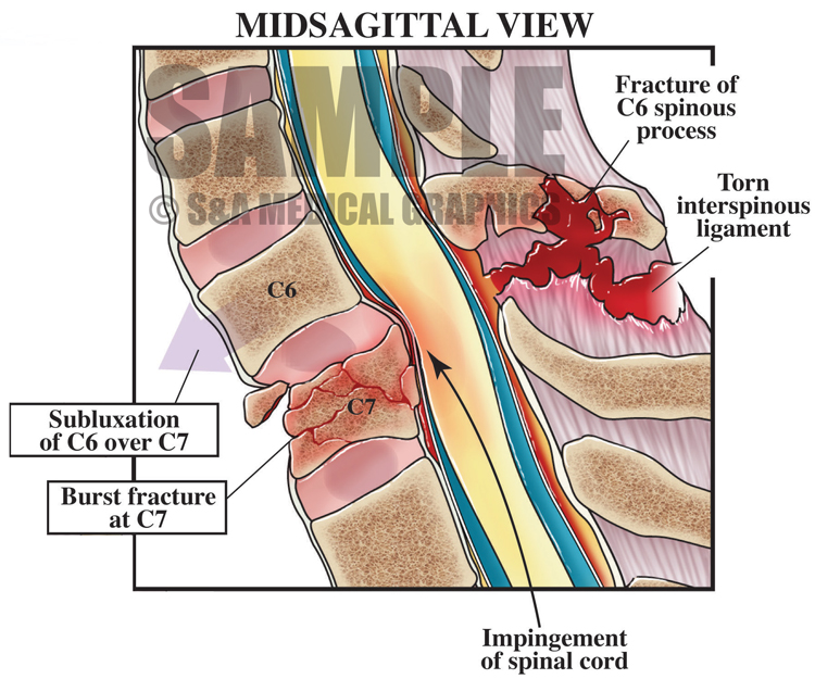 Cervical Spine Injury S&A Medical Graphics
