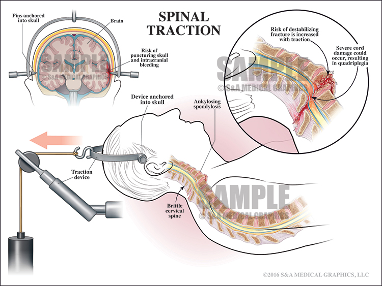 Cervical Injury Stabilization S&A Medical Graphics