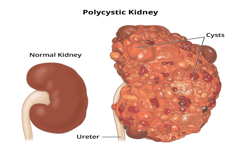 Research on Polycystic Kidneys Free Essay Examples