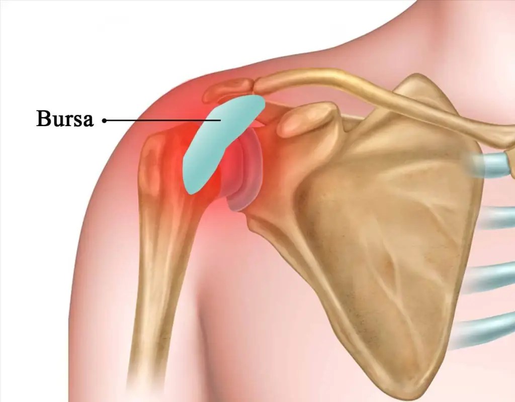 Shoulder Pain Samvedna Pain Clinic