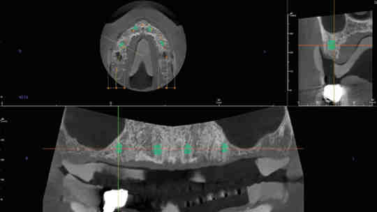 Can You Have An Mri With Dental Implants » Dental News Network