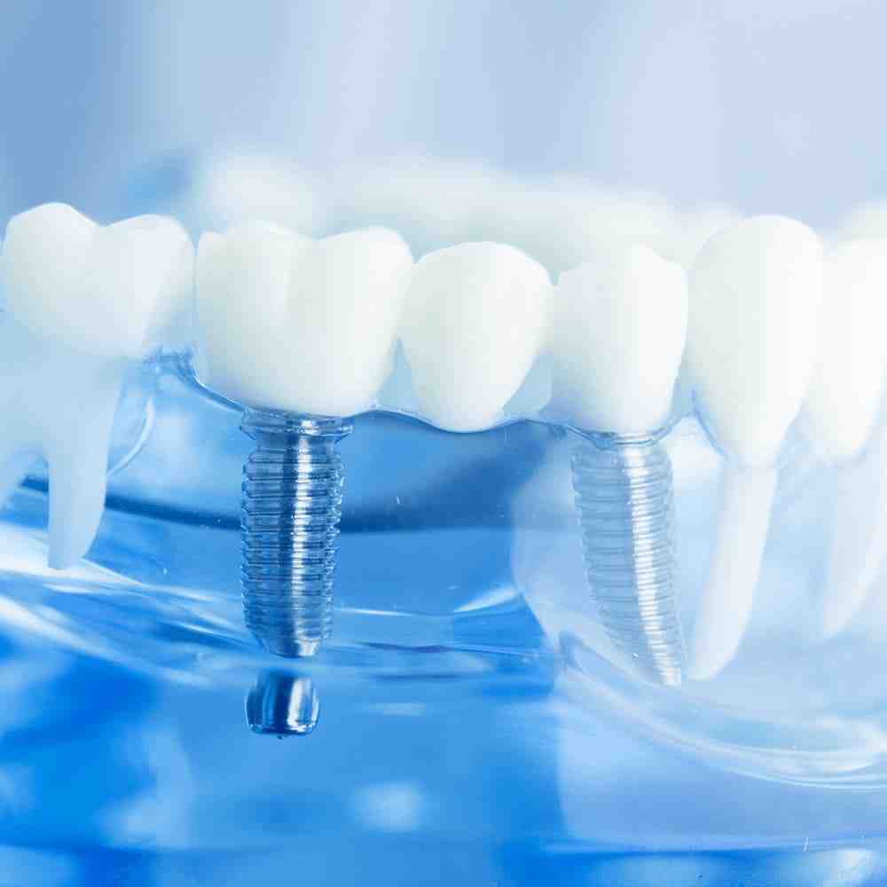 Dental Implant Healing Stages Everything You Need to Know