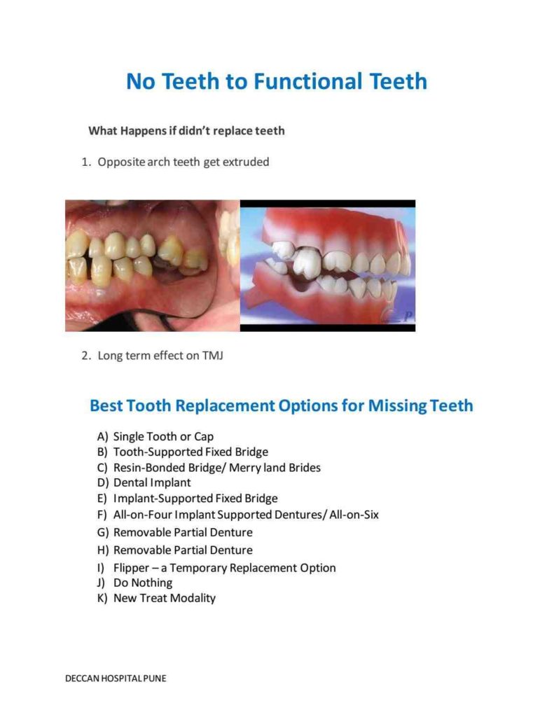 Are dental implants permanent Dental News Network