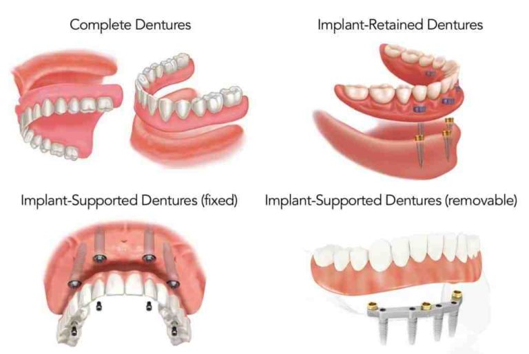Are dental implants removable Dental News Network