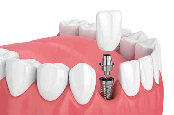 When did dental implants popular Dental News Network