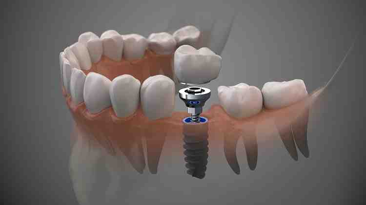 How long does it take to recover from dental implant surgery?