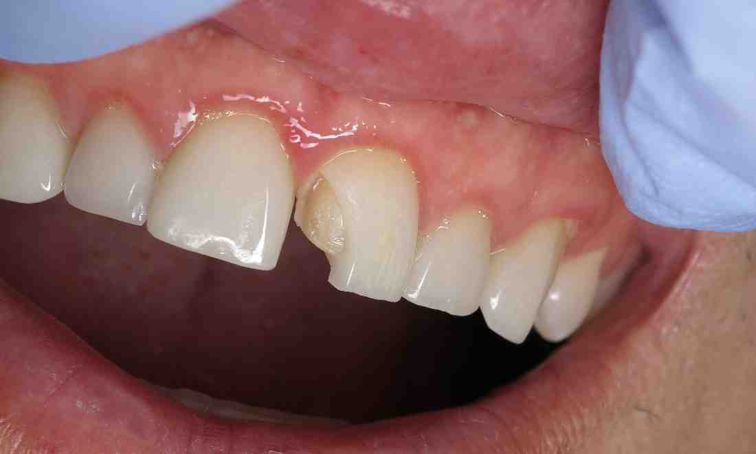 Cosmetic dentistry same day veneer Dental News Network