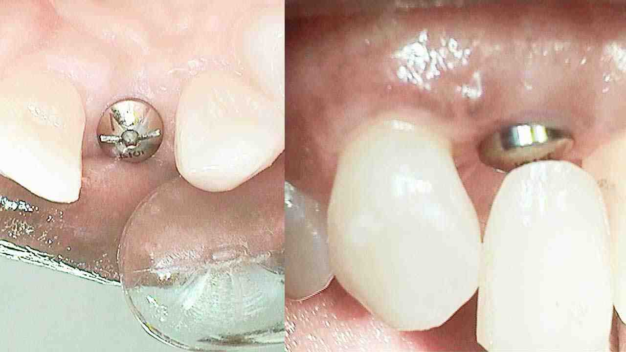 How much do full upper dental implants cost Dental News Network