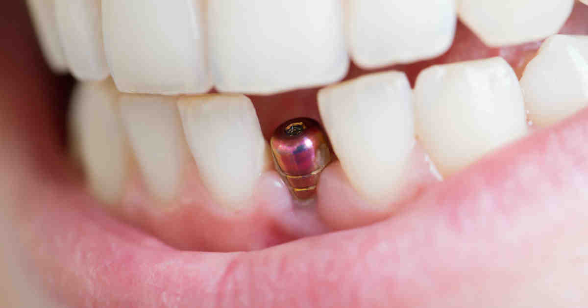 When is the best time to put dental implant in, right after tooth