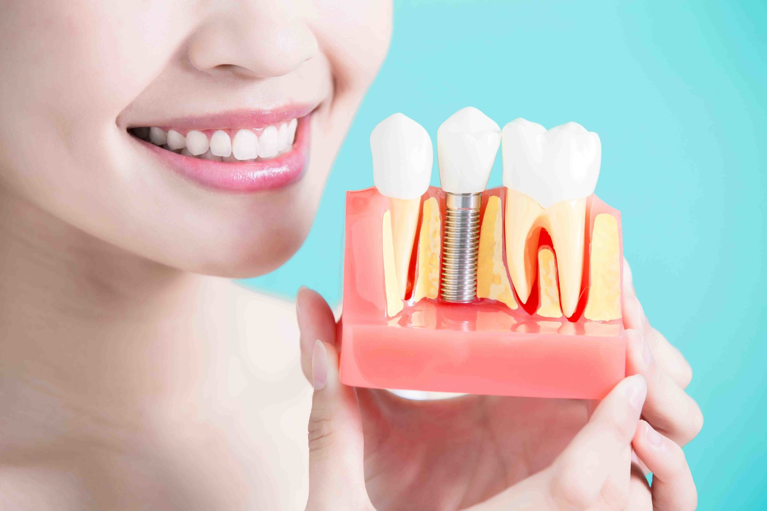 What to know before getting dental implants Dental News Network