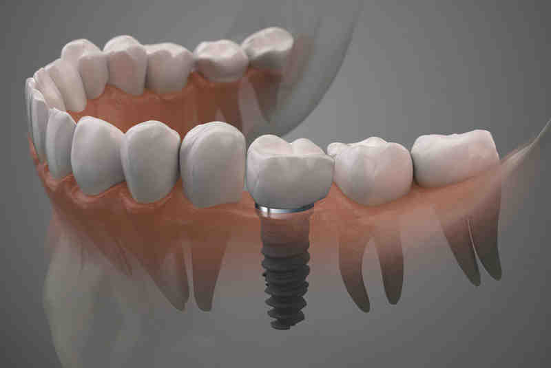How long does the pain last after a dental implant Dental News Network