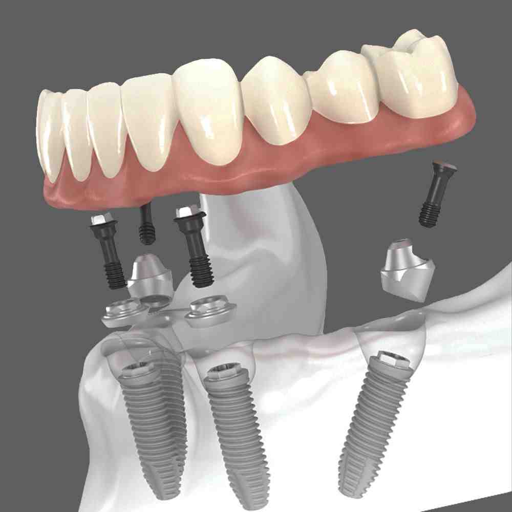 What to expect with allon4 dental implants Dental News Network
