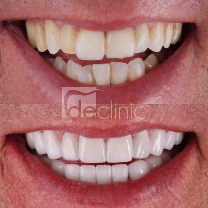 Do you need straight teeth before veneers? Dental News Network