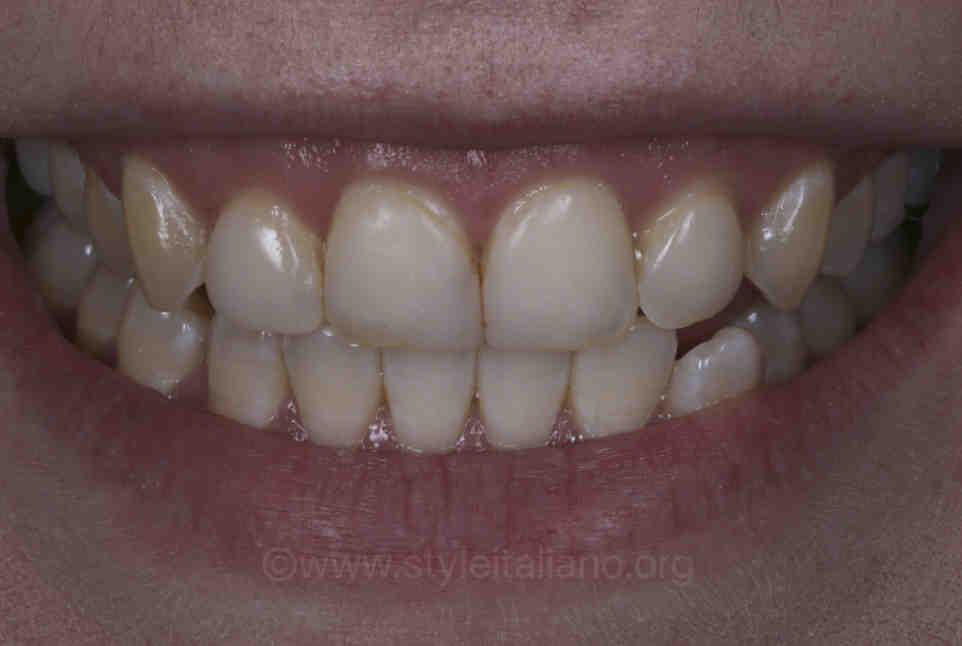How many times can you redo veneers? Dental News Network