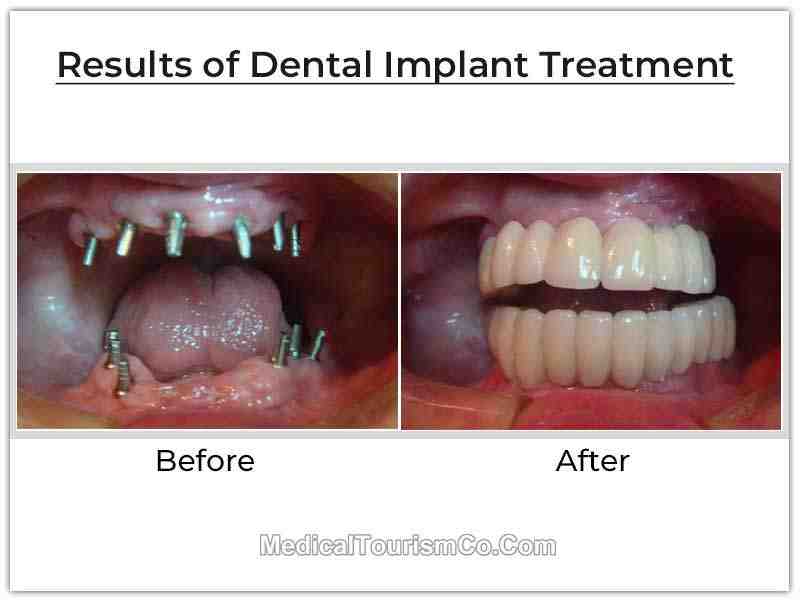 What is the cost of full mouth dental implants in mexico? Dental News