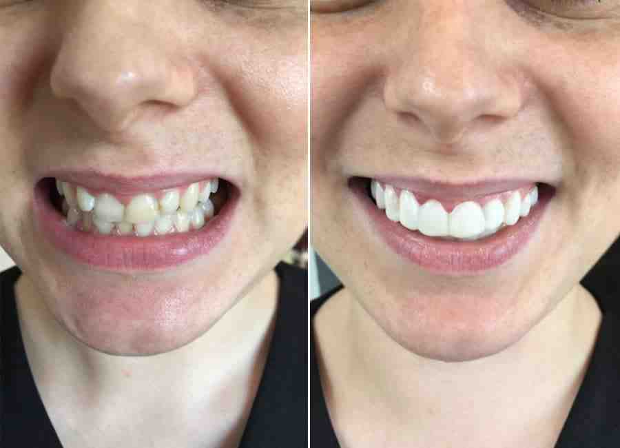 How much is it to get veneers in Mexico? Dental News Network
