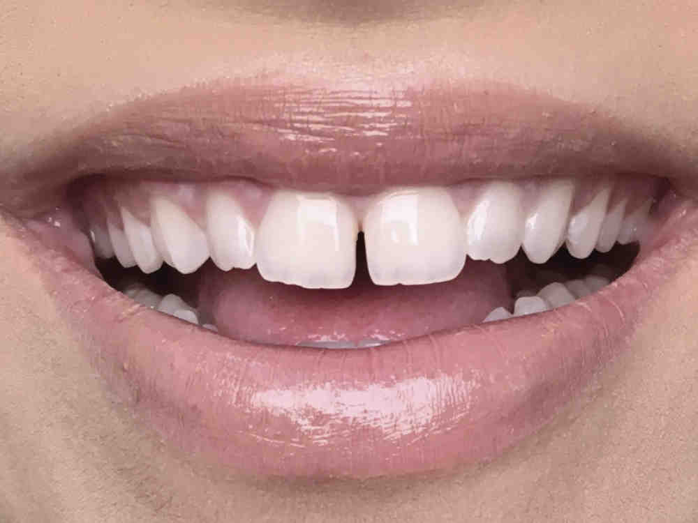 How many times can you redo veneers? Dental News Network