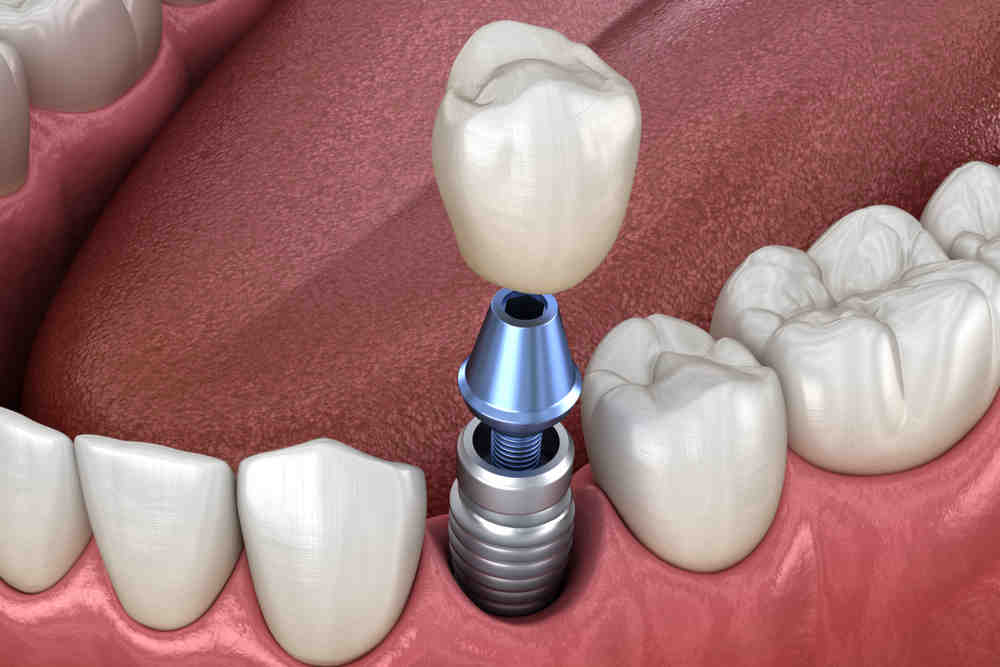 Do i need sedation for dental implants Dental News Network
