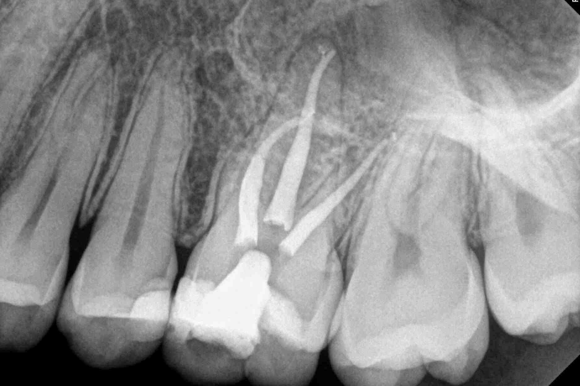 Can you have 2 root canals on the same tooth? Dental News Network