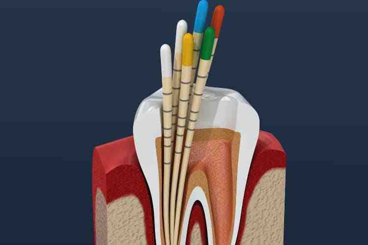 How long does a root canal last? Dental News Network