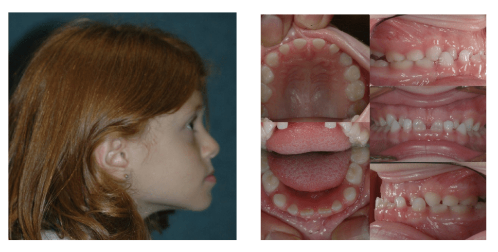 When Is Twophase Orthodontics Beneficial Part II