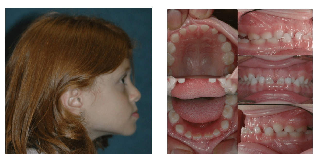 When Is Twophase Orthodontics Beneficial Part II