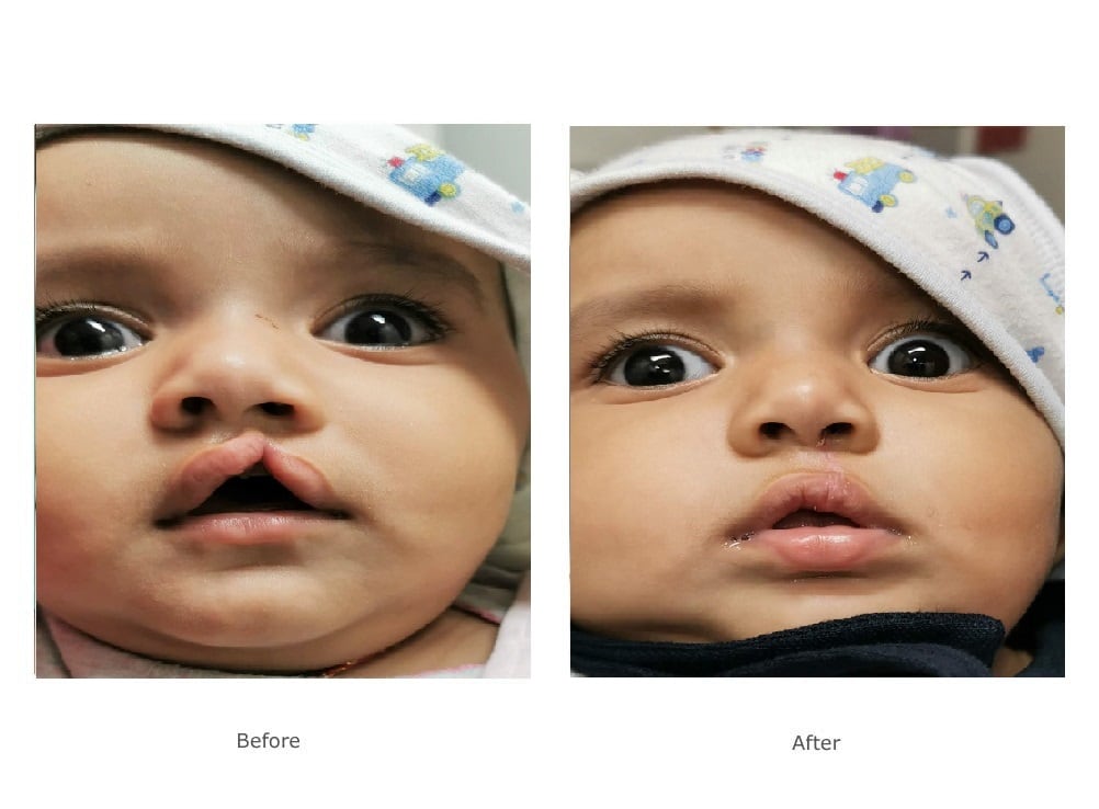 9 month old baby with birth defect of cleft lip and nose deformity. 2 weeks following plastic