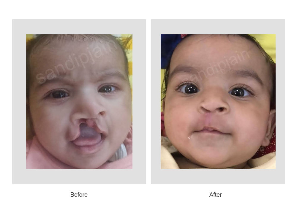 Cleft Lip Surgery Before And After