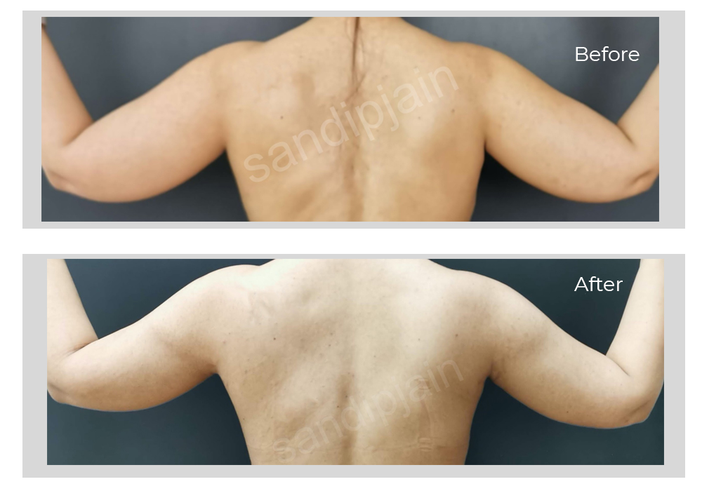 Before heavy arms with no definition After following smart