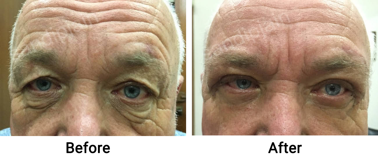 Patient showing severe wrinkling of forehead, heavy upper eyelids and
