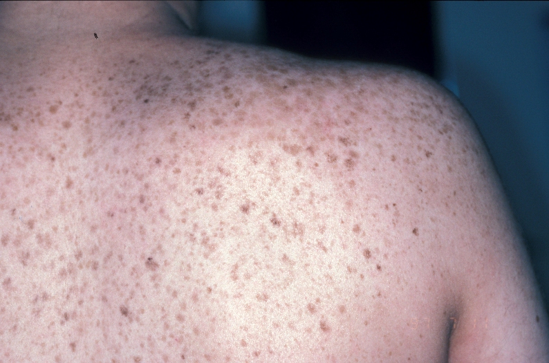 White bumps skin on arms