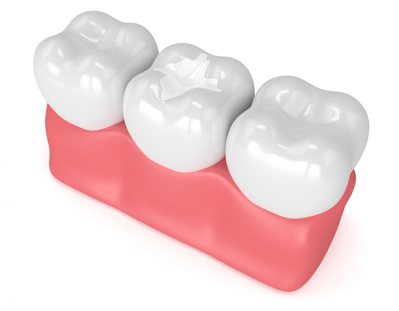 Dental Fillings Hammond Dental Dentist in Sandy Springs, GA