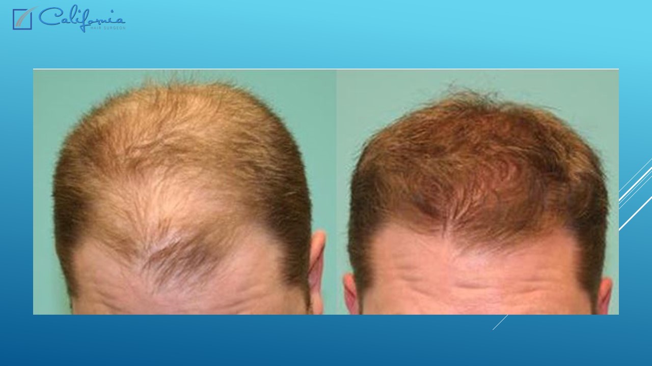 Hair Transplant San Francisco Medical & Surgical Hair Restoration in