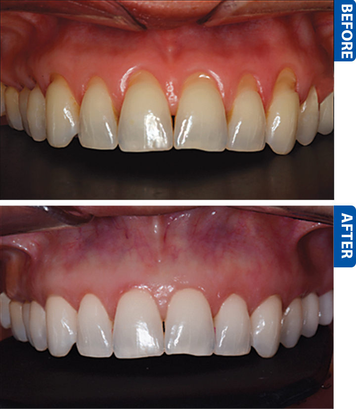 Gum Recession Treatment in Bakersfield Martha H. Sanger DDS