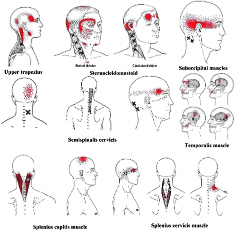 Headache Patterns ⋆ Santa Barbara Deep Tissue Riktr PRO Massage